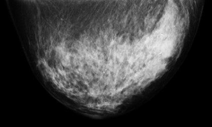 Black and white image of a 2cm diameter ductal carcinoma